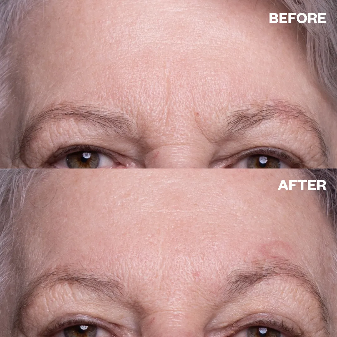 Eye & Forehead Wrinkle Patch Multi-Pack